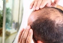 Baldness Causes Stages Treatments