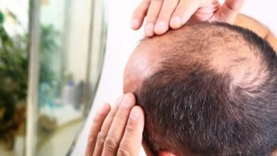 Baldness Causes Stages Treatments