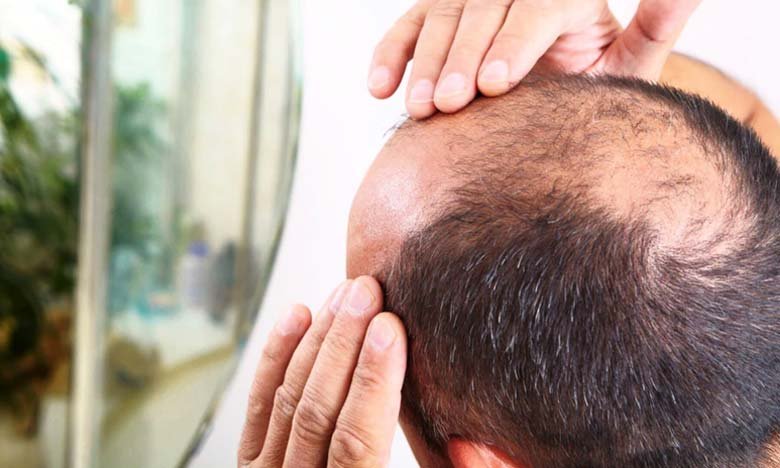 Baldness Causes Stages Treatments